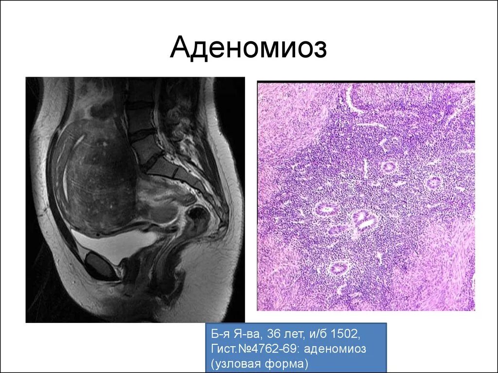 Как лечится аденомиоз