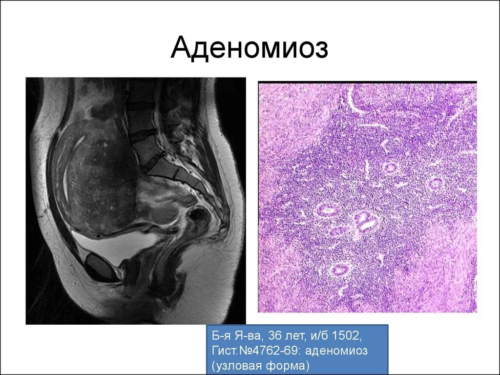 При аденомиозе можно забеременеть. Аденомиома матки гистология. Узловая форма эндометриоза матки. Эндометриоз Узловой диффузный.