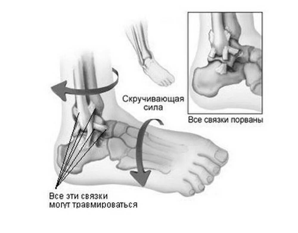 Надорваны связки голеностопа. Эргономика голеностопного сустава. Мрт разрыв связок голеностопа. Перелом с вывихом голеностопного. Трещина связке