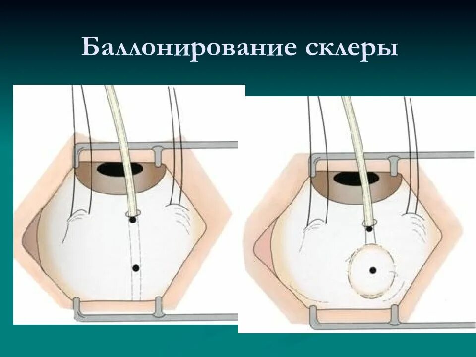 Как обрести фигуру мечты. Баллонирование. Внутрижелудочный баллон для похудения. Внутрижелудочный баллон для похудения производители. Внутрижелудочный баллон производители.