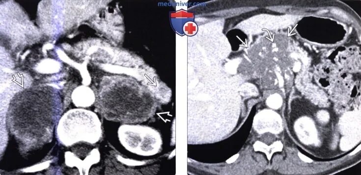 Лимфома поджелудочной железы кт. Карцинома поджелудочной железы кт. Гастринома поджелудочной железы кт. Метастазы в поджелудочной железе на кт. Лимфаденопатия ворот печени