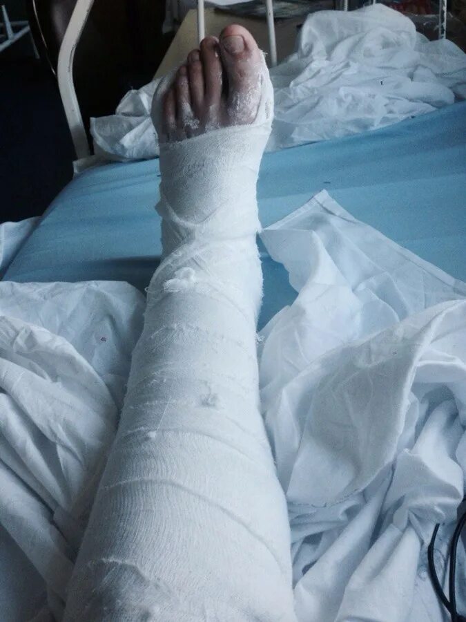 гипс на ноге отзывы