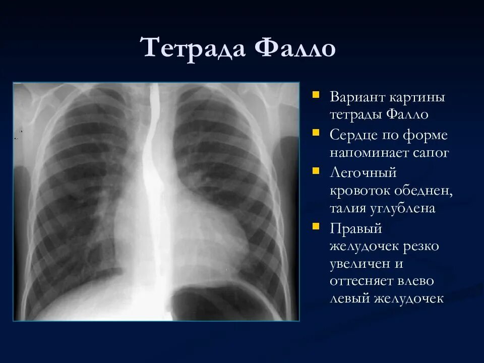 Норма форма сердца. Рентген при Тетрада Фалло. Тетрада Фалло рентген признаки. Тетрада Фалло рентгенодиагностика. Врожденный порок сердца рентген.