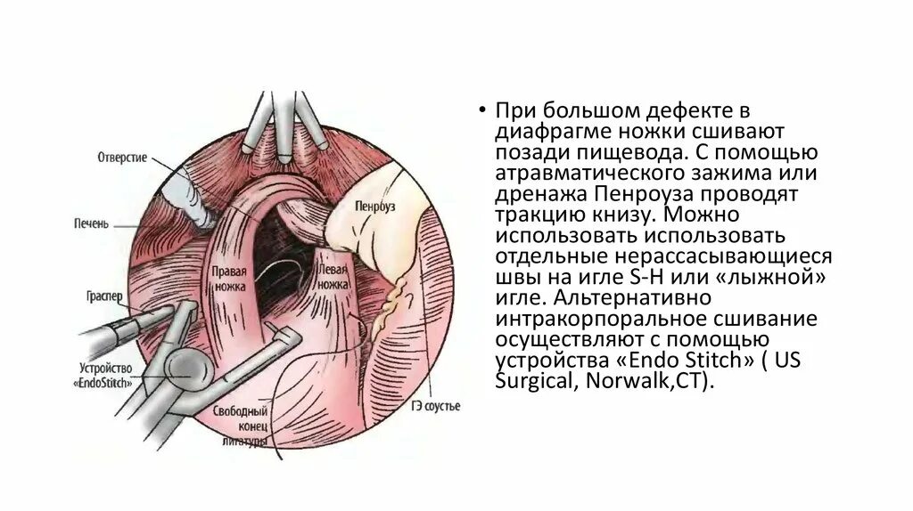 Ножки диафрагмы и пищевод. Диафрагма ножки диафрагмы. Отверстие в печени