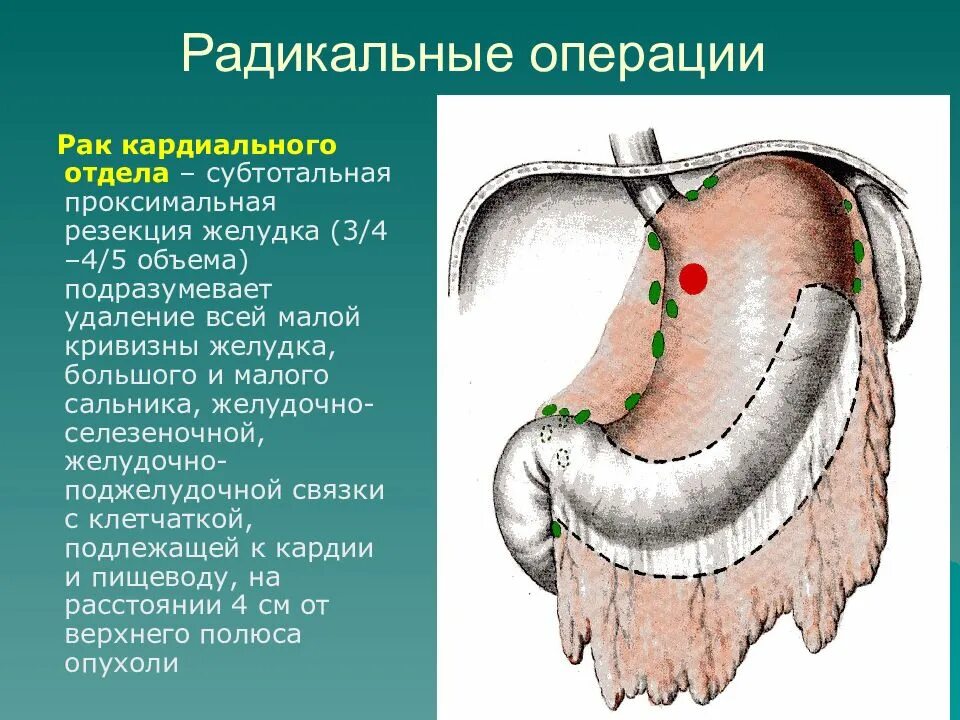 Проксимальная субтотальная резекция желудка. Кардиального отдела желудка. Привратник желудка опухоль. Малая кривизна желудка.