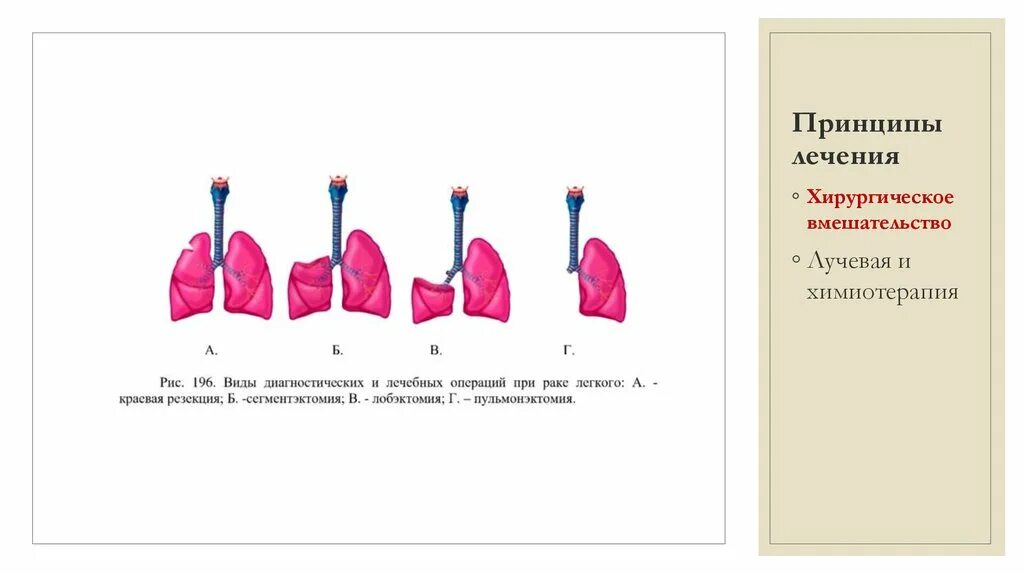 Принципы лечения легких. Хирургическое лечение легких. Бронхопластические операции.