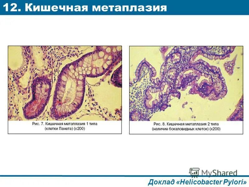 Язвенная болезнь желудка и 12 перстной профилактика. Хеликобактер чебоксары. Хронический гастрит статистика заболевания в россии. Heli cure для желудка. Хеликобактер чебоксары.