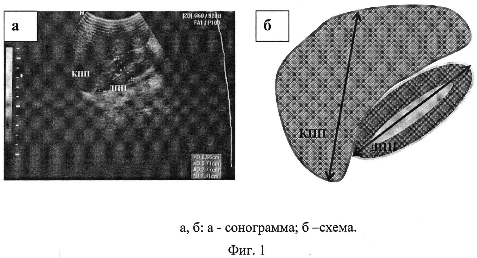 Измерение селезенки на УЗИ. Измерение печени на УЗИ. Измерение размеров печени на УЗИ. КВР печени УЗИ. Узи печени схема