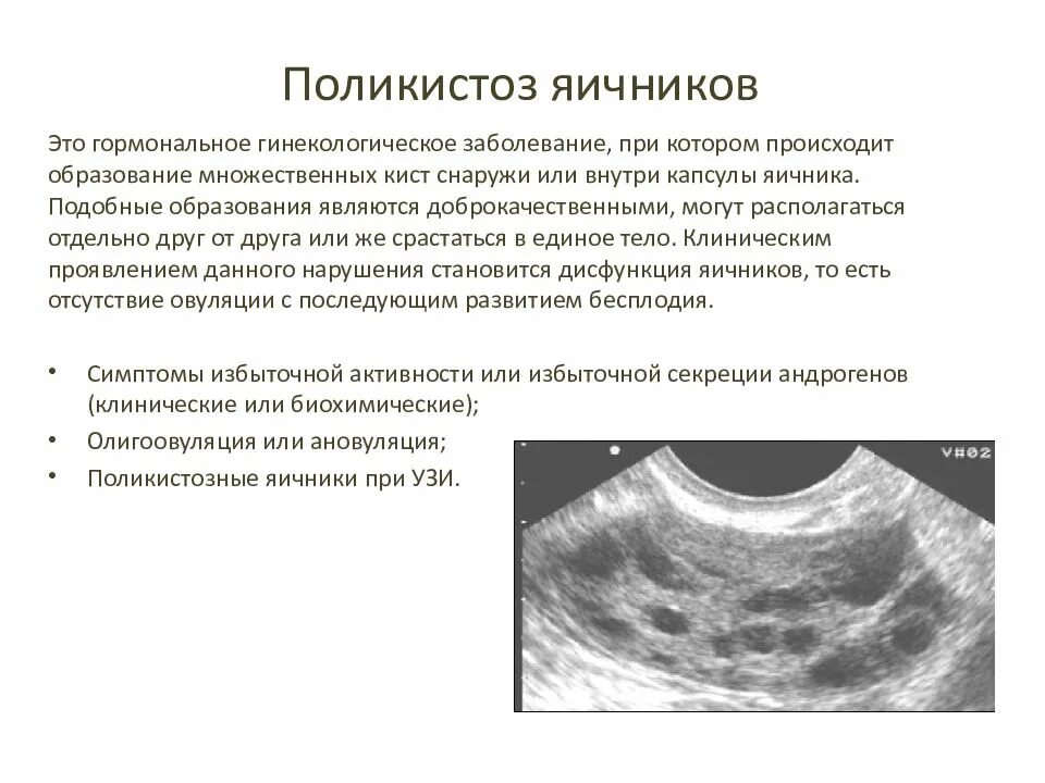 УЗИ признаки поликистоза яичников. УЗИ поликистозных яичников описание. Поликистоз яичников УЗИ критерии. Ультразвуковые критерии поликистозных яичников. Мфя в гинекологии что