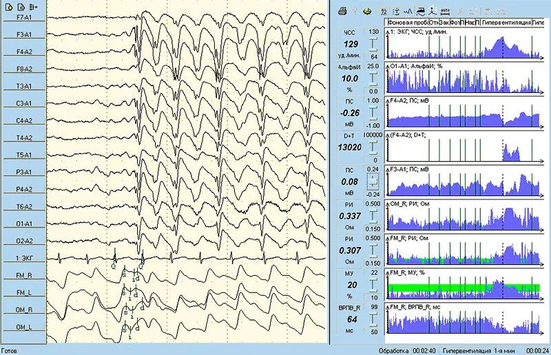 Электроэнцефалограмма (ЭЭГ) электрокардиограмма (ЭКГ). ЭЭГ сигнал. Реоэнцефалограмма норма. ЭКГ ЭЭГ расшифровка. Ээг красноярск