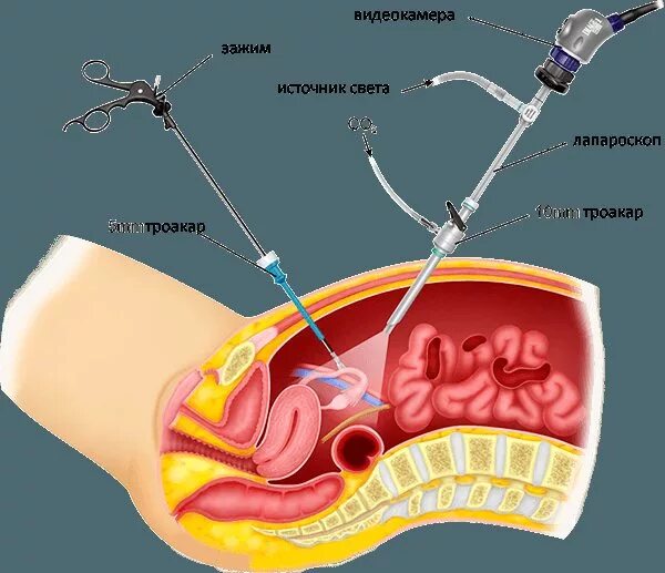 Удаление мочевого пузыря сколько. Видеолапароскопическая аппендэктомия. Лапароскопическая аппендэктомия лапароскопия. Диагностическая лапароскопия острый аппендицит. Аппендикулярный инфильтрат диагностическая лапароскопия.