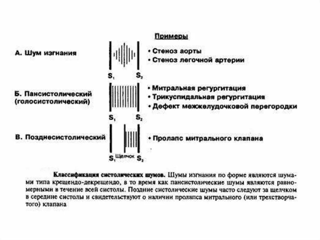 Классификация систолических шум в сердце. Классификация систолического шума. Голосистолического шума. Шумы сердца при аортальном стенозе. Систолический шум это