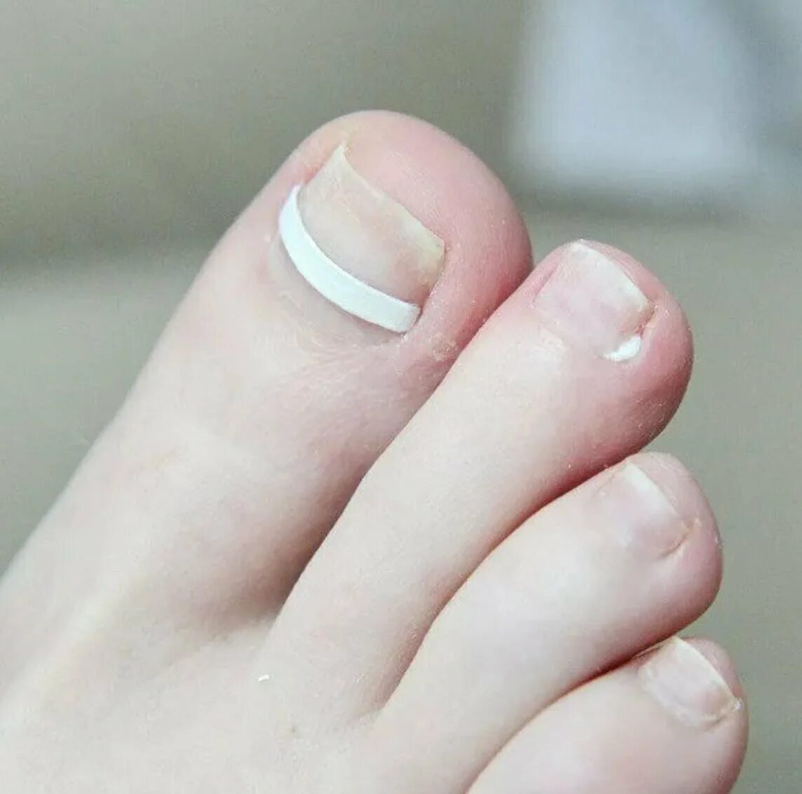 Ортониксия скоба пластина титановая нить. Подногтевой онихомикоз. Система коррекции вросшего ногтя podofix. Ортониксия титановая нить. Подолог пластины.