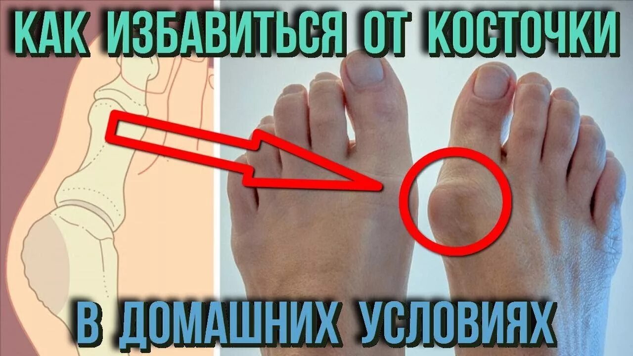 На ноге косточка болит это что. Болят плюсневые кости свода стопы. Вальгусная деформация пальца стопы. Появилась косточка на ноге. На ноге косточка болит это что.