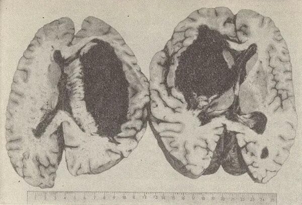 Гематома мозга патанатомия. Геморрагический инсульт патологическая анатомия. Диффузная инфильтрация Гохзингера. Кровоизлияние в мозг патанатомия. Кровоизлияние в желудочки