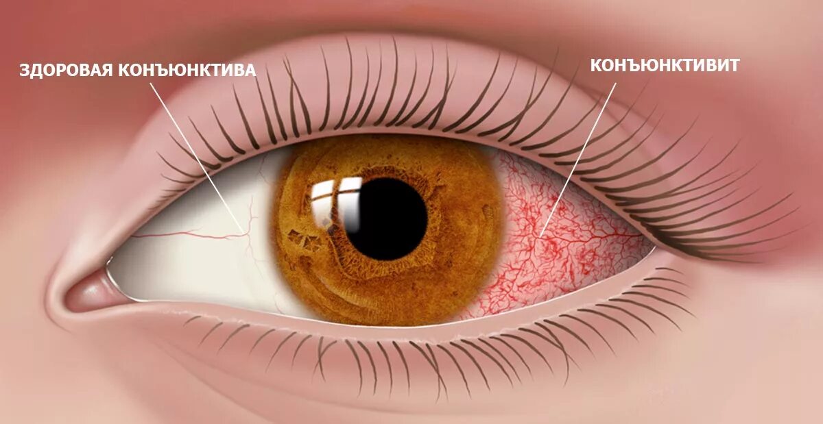 Конъюнктивит какие симптомы. Аденовирусная инфекция конъюнктивит. Гигантский папиллярный конъюнктивит. Эписклерит конъюнктивит. Аденовирусный конъюнктивит симптомы.