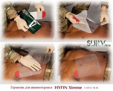Окклюзионная повязка при клапанном пневмотораксе