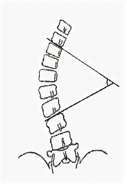 Метод Кобба сколиоз. Угол Кобба степени сколиоза. Угол Кобба и Чаклина. Угол сколиоза метод Кобба. Угол кобба