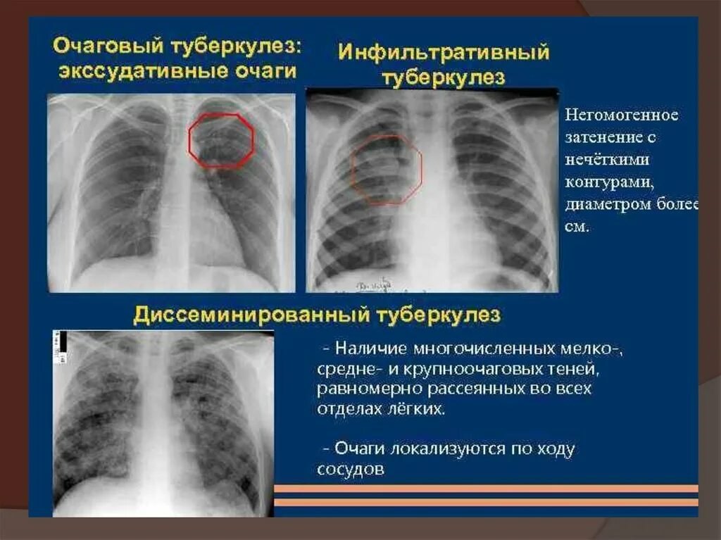 Множественные округлые. Фиброзно очаговый туберкулез рентген. Инфильтративный туберкулез рентген. Очаговый туберкулез туберкулез кт. Очаговый туберкулез рентген.