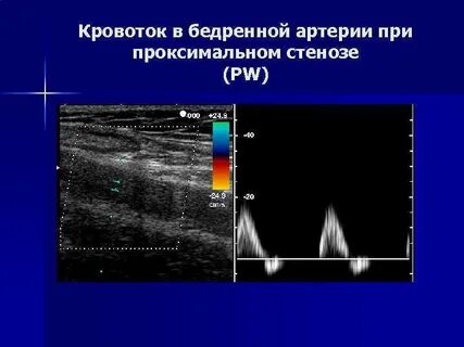 Виды кровотока в артериях
