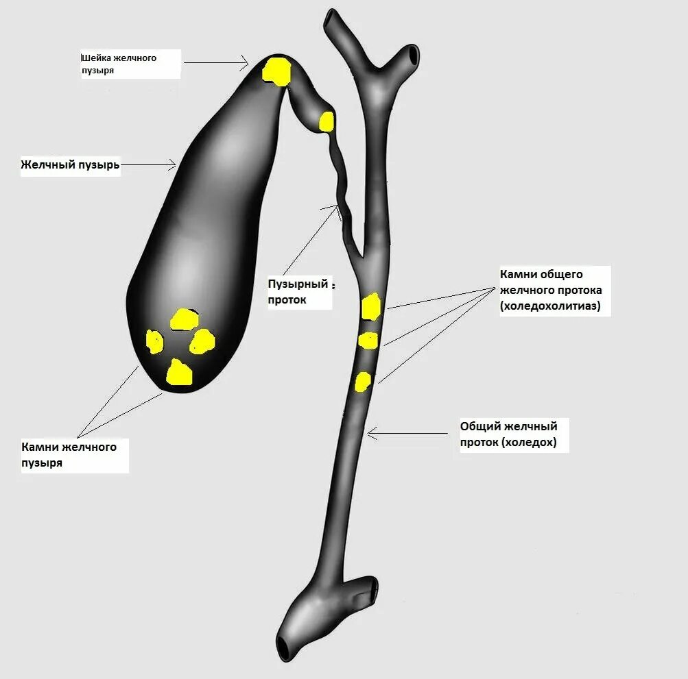 Камни в протоках желчного пузыря. Конкремент в шейке желчного пузыря. Желчный пузырь холедохолитиаз. Камень в протоке желчного пузыря.