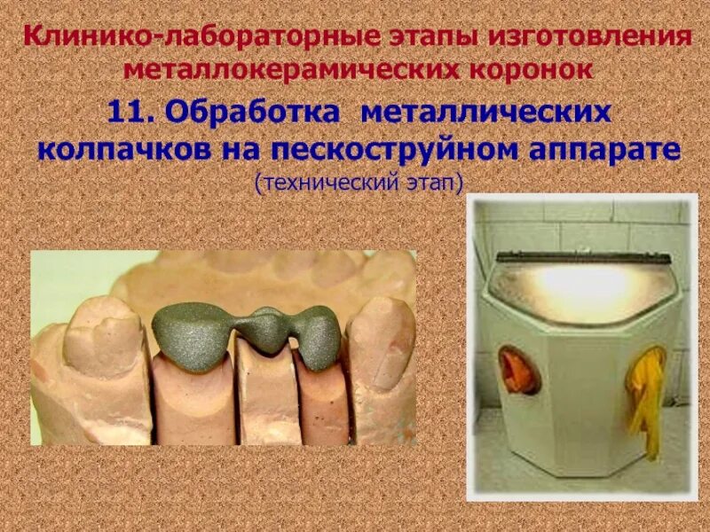 Этапы изготовления металлокерамической коронки. Лабораторные этапы изготовления металлокерамической коронки. Керамика металл коронка. Технология керамической коронки. Лабораторные этапы металлокерамической коронки