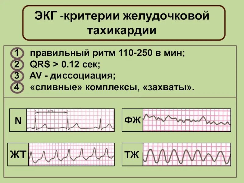 Желудочковая тахикардия на экг