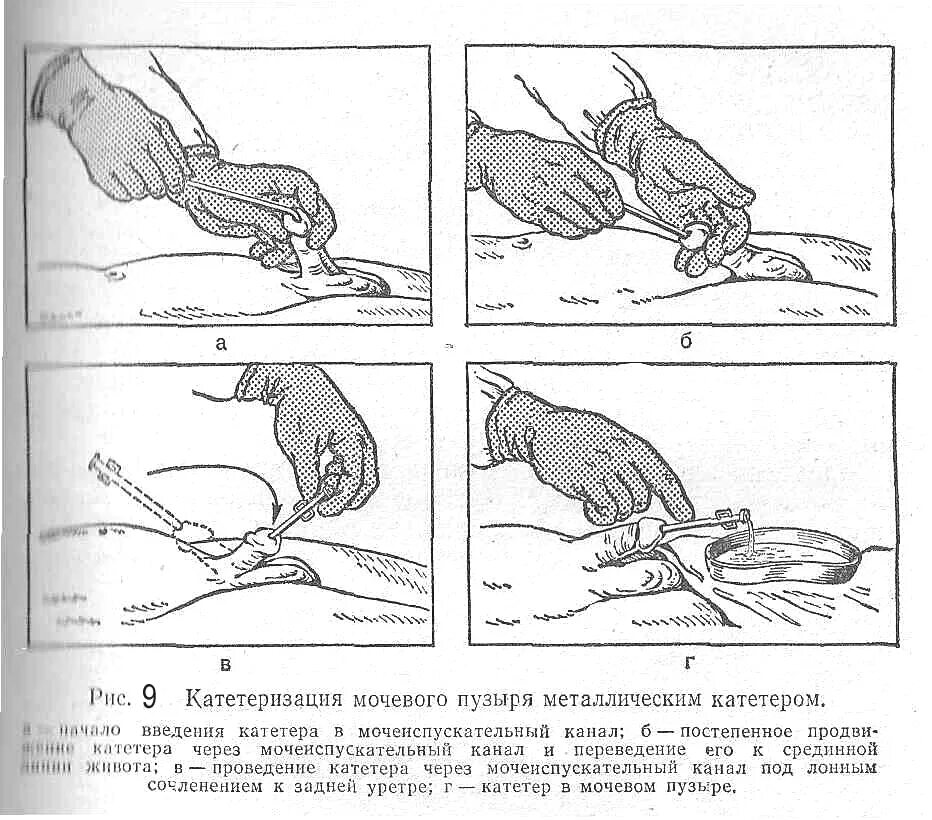 Катетеризация мочевого пузыря. Алгоритм использования мочевого катетера. Постановка мочевого катетера алгоритм. Алгоритм катетеризации мочевого пузыря катетером. Техника катетеризации мочевого пузыря мягким катетером алгоритм.