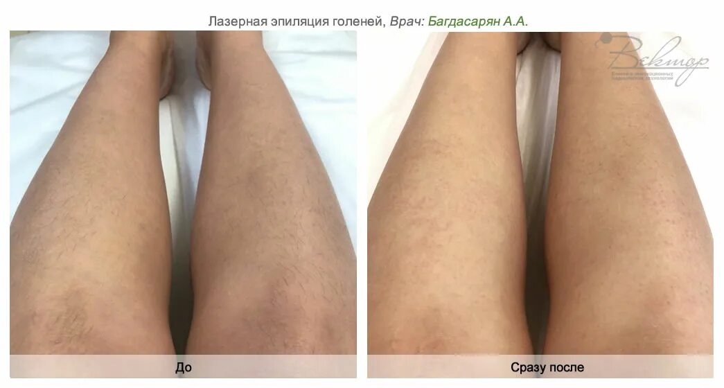 Лазерная эпиляция ноги skinlift. Лазерная эпиляция. Лазерная эпиляция голени. Лазерная эпиляция голени до и после.