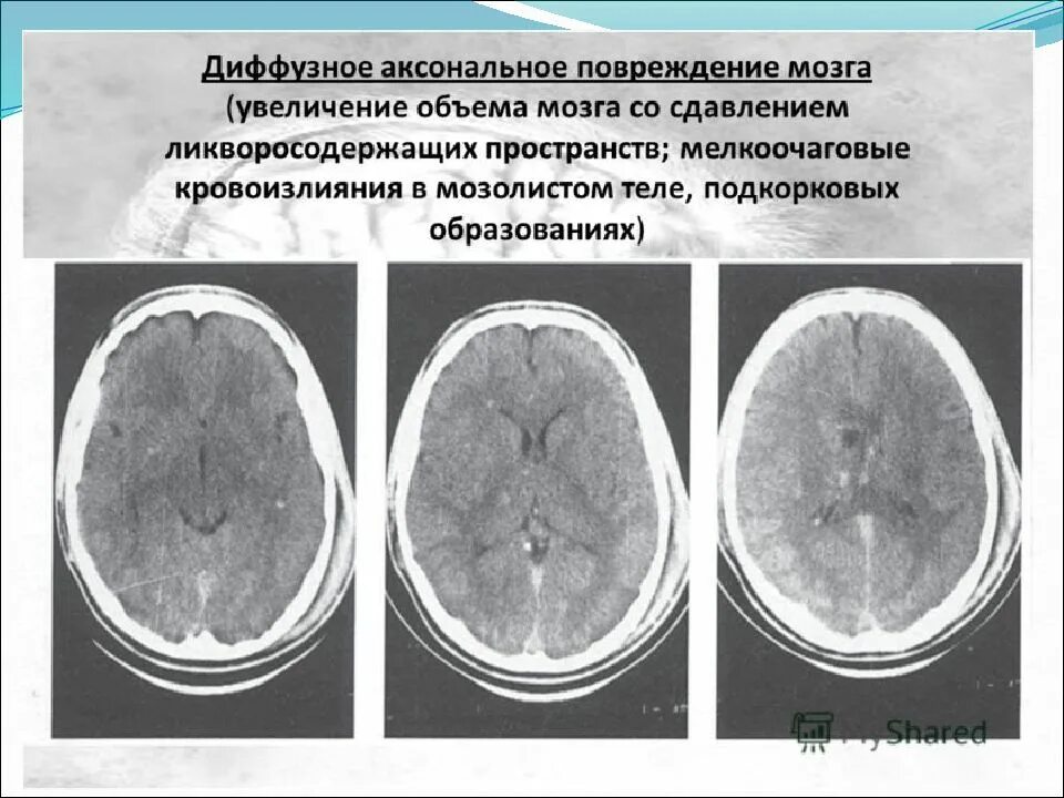 Диффузное поражение головного мозга