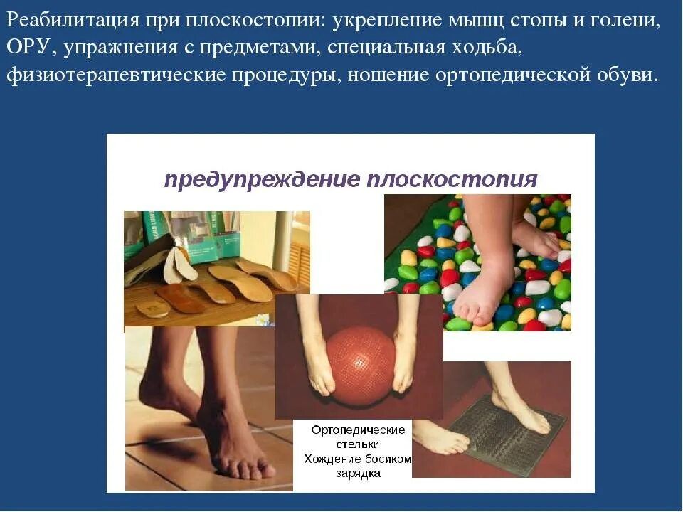 Плоскостопие может быть предотвращено