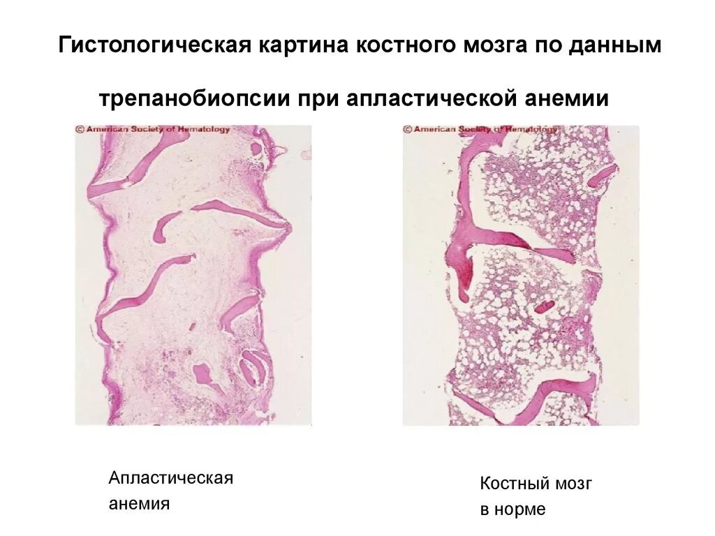 Жировое изменение костного мозга. Апластическая анемия патанатомия. гистологическая картина костного мозга при апластической анемии. костный мозг при гипопластической анемии.