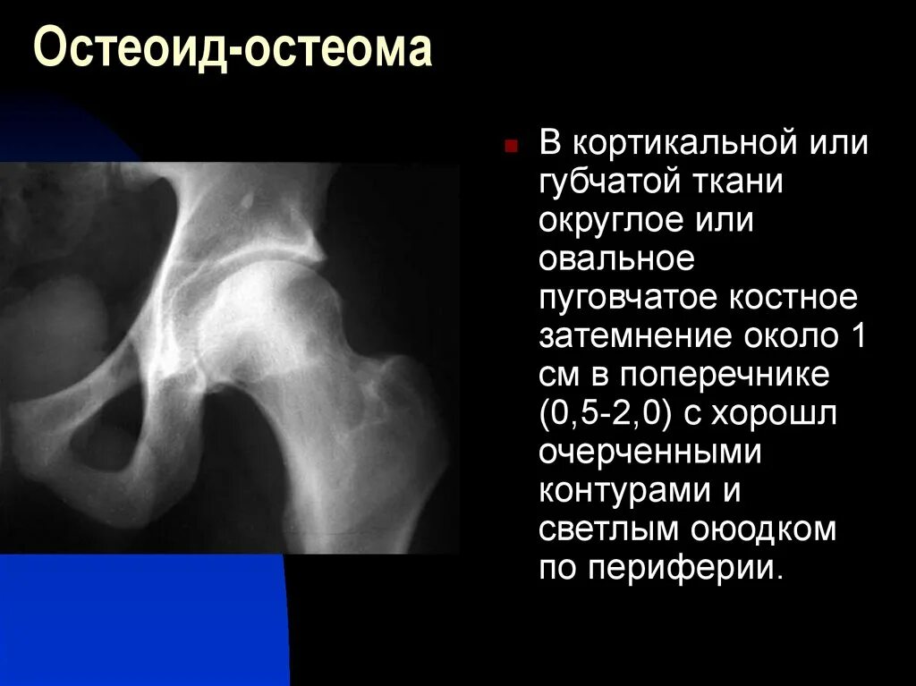 Губчатая остеома большеберцовой кости на кт. Остеома бедренной кости на кт. Признаки остеомы. Губчатая остеома рентген. Остеома доброкачественная рентген.