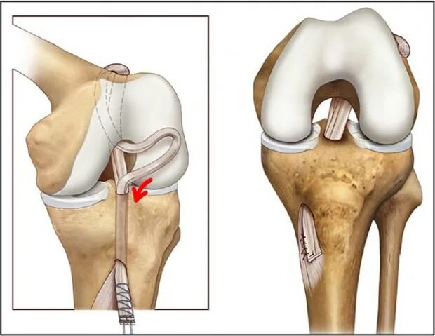 Крестовидная коленная связка. ПКС (передняя крестообразная связка). Разрыв связок коленного сустава ПКС операция. Артропластика ПКС коленного сустава. Артроскопия пластика крестообразной связки ПКС коленного сустава.