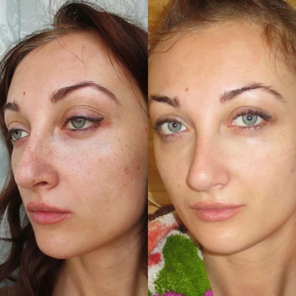 Разрушение пигментов. Пигментация на лице до и после. Выведение пигментных пятен лазером. Отбеливание кожи лазером. Отбеливание кожи до и после.