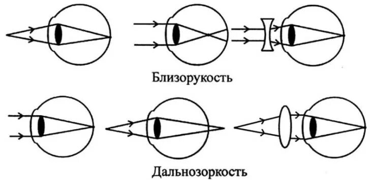Какие точки зрения на причины и способы. Дефекты зрения близорукость и дальнозоркость. Что такое близорукость (миопия) и дальнозоркость (гиперметропия). Миопия и гиперметропия линзы. Близорукость схема глаза.