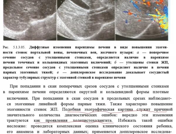 Протоковые изменения в печени. Диффузно очаговая паренхима печени. Диффузно-очаговые изменения селезенки. Паренхима печени диффузно изменена.