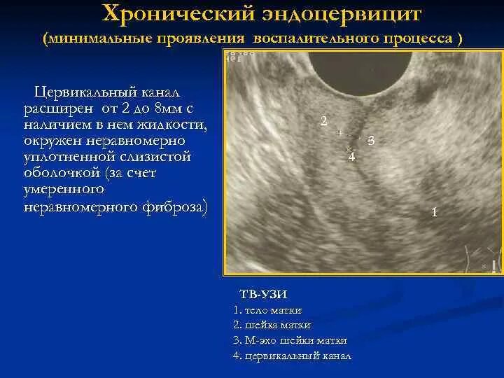 Цервицит и эндоцервицит. Эндоцервицит шейки матки УЗИ. Папиллярный эндоцервицит. Хронический эндоцервицит.