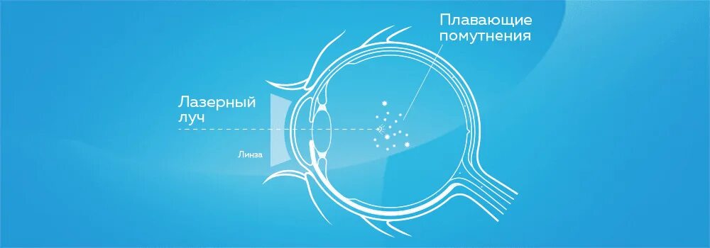 Плавающая черная точка в глазу что это. Плавающие точки в глазах. Деструкция стекловидного тела (плавающие «мушки»). Лазерный витреолизис и стекловидное тело /. Стекловидное тело глаза плавающие точки перед глазами.