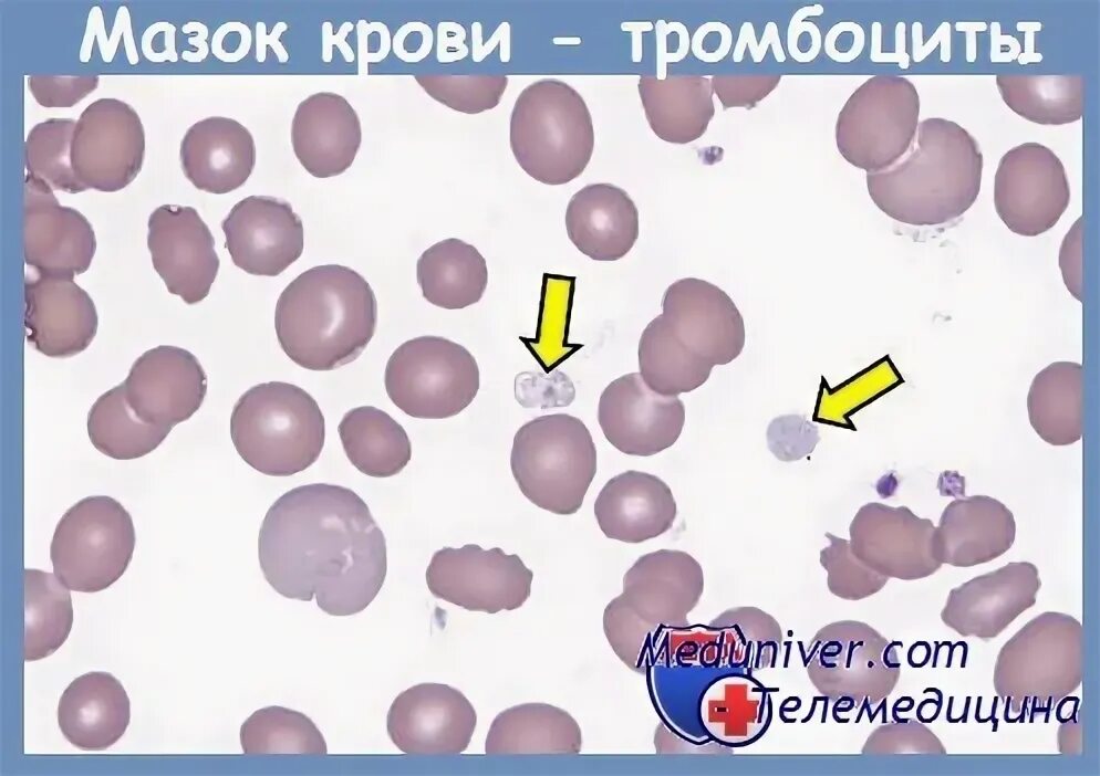 Количество тромбоцитов по фонио. Количество тромбоцитов по фонио