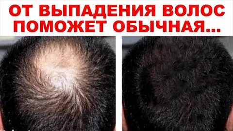 Выпадают волосы на голове народные средства