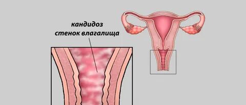 Дисбактериоз и молочница