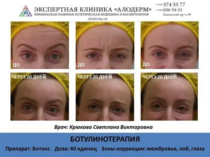 Сколько диспорта нужно на лоб и межбровье