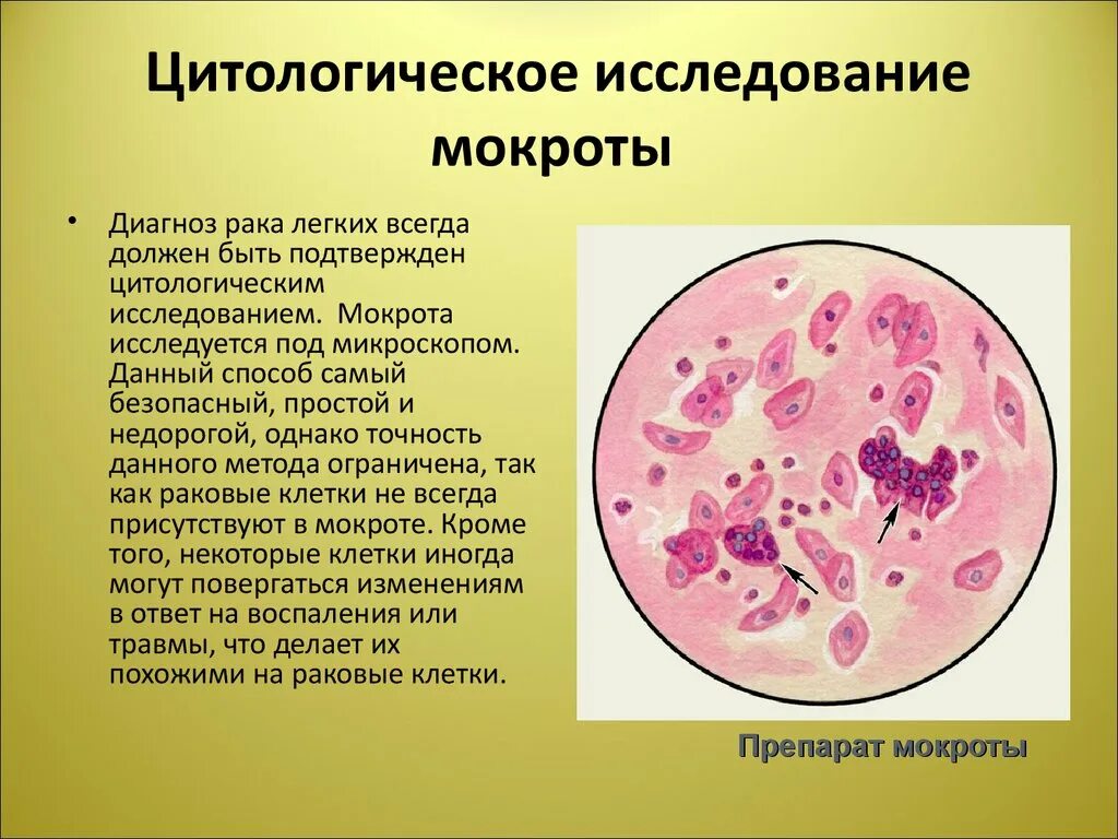 Анализ мокроты легких. Цитологическое исследование. Цитологическое исследование мокроты. Исследование атипических клеток мокроты. Методы исследования мокроты.