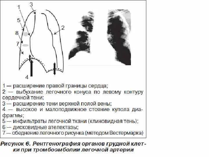 Дилатация правых отделов. Тромбоэмболия лёгочной артерии симптомы рентген. Тромбоэмболия легочной артерии УЗИ. Эмболия легочной артерии рентген. Тромбоэмболия легочной артерии рентген.