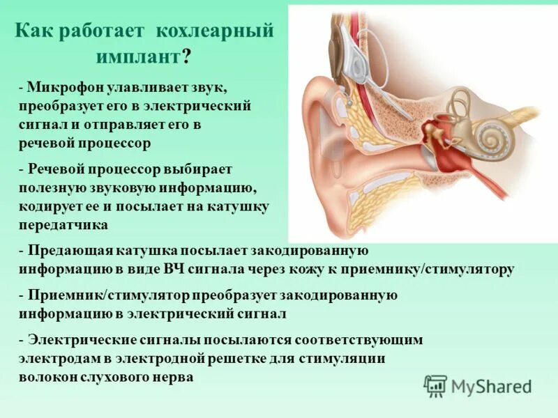 Какое давление в среднем ухе. Речевой процессор кохлеарного импланта. Имплантируемые слуховые аппараты среднего уха. Операция по кохлеарной имплантации. Как работает кохлеарный имплант.