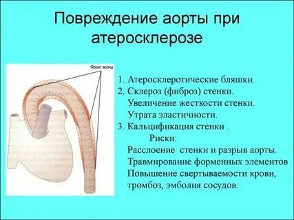 Склероз аортального клапана