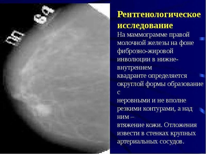 Признаки фиброзных изменений молочных. Маммография жировая фиброзная ткань. Фиброзно железистая структура молочной железы. Кистозная мастопатия маммография. Фиброзно жировая инволюция молочной железы маммограмма.