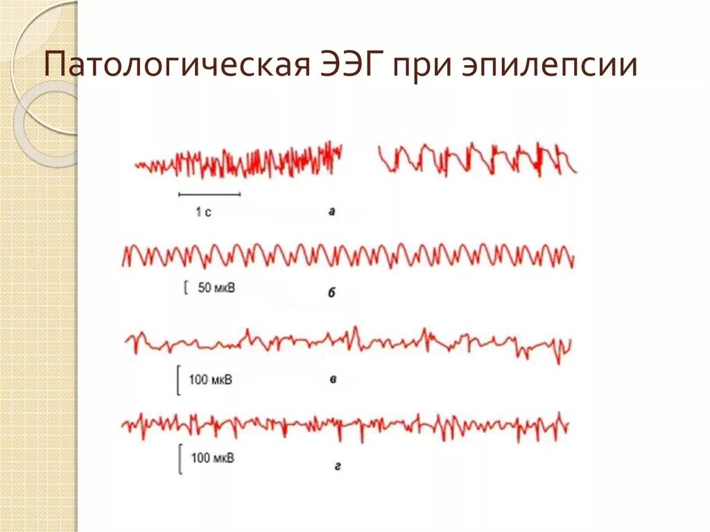 Здоровая ээг. ЭЭГ энцефалограмма эпилепсия. ЭЭГ волны эпиактивность. ЭЭГ здорового человека и эпилептика. Электроэнцефалография, норма, ЭЭГ, видеомониторинг ЭЭГ при эпилепсии\.