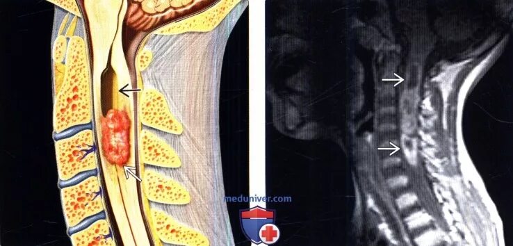 Интрамедуллярная опухоль спинного мозга шейного отдела позвоночника. Интрамедуллярное образование спинного мозга. Интрамедуллярная киста спинного мозга. Интрамедуллярная опухоль спинного мозга грудного отдела. Интрамедуллярные опухоли спинного